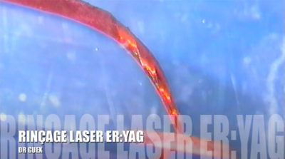 Rinçage avec le laser er:yag