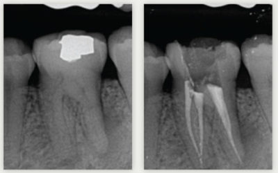 Tooth mineralization and root canalization