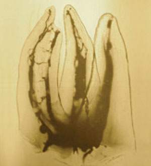 Maxillary transparent molar