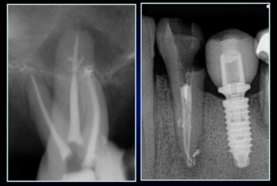 Cleaning of the lateral canals