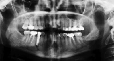Dental panoramic radiography