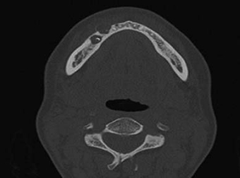 Radiographie : corticale vestibulaire soufflée