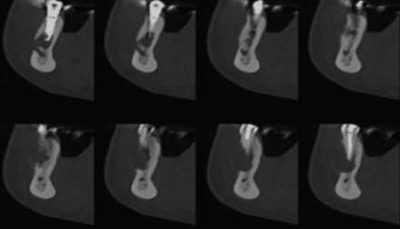 Radiographie : foramen mentonnier et kyste
