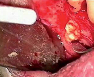 Cyst facing 44 forming the cuts