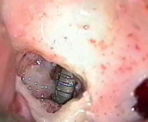 Implant granuloma highlighted by osteotomy