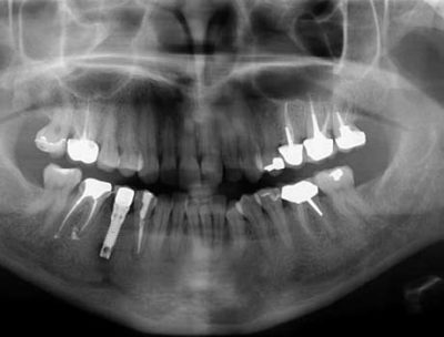 Radiographie panoramique dentaire de contrôle