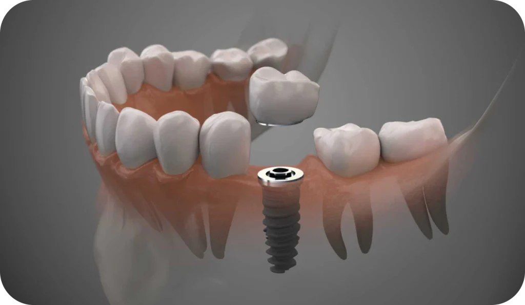 Implant unitaire
