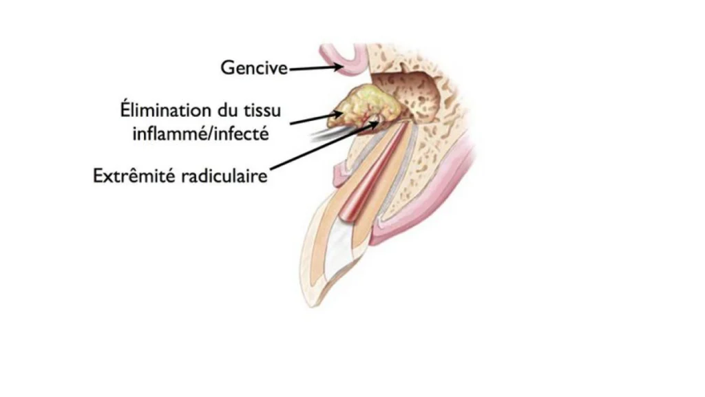 Micro chirurgie endodontique