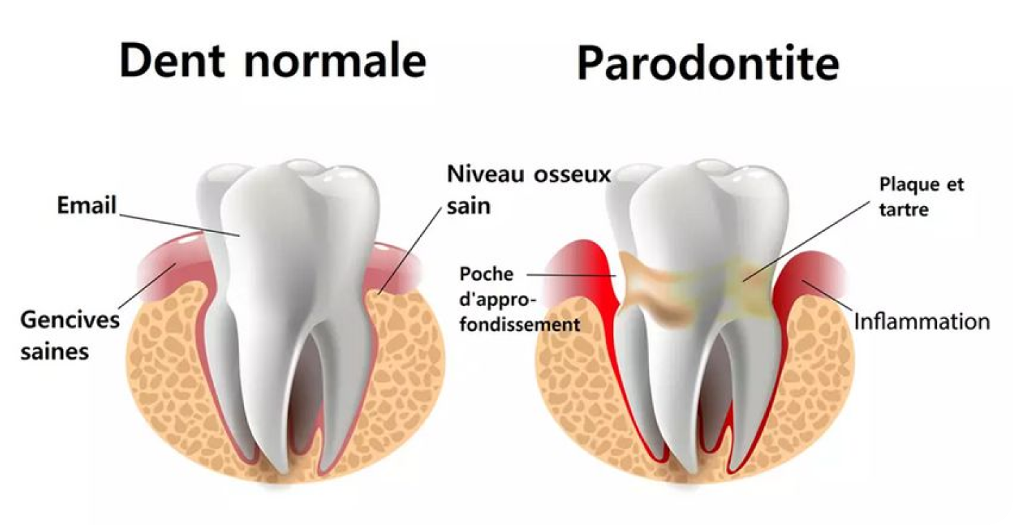Soins parodontaux